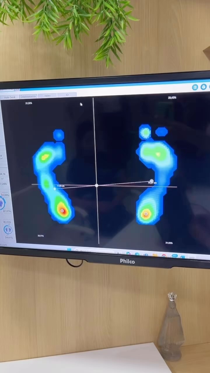 Avaliação da pisada e indicação de palmilha postural